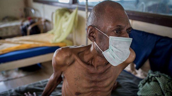 Tuberculosis patient