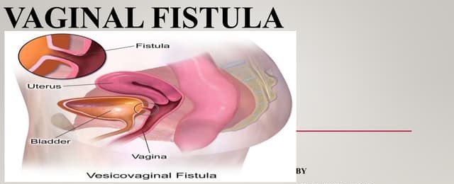 vaginal fistula